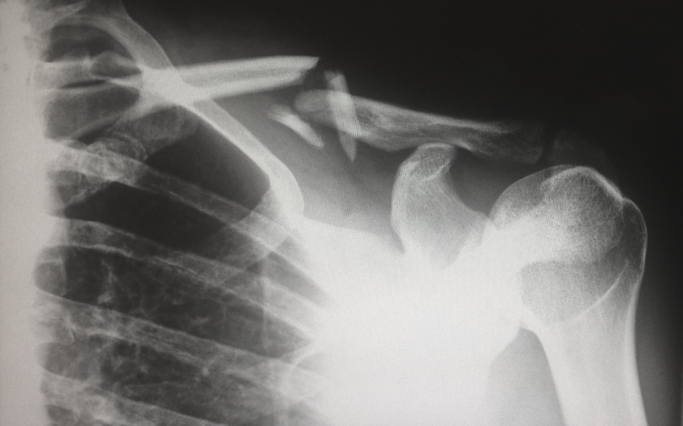 Shoulder Injuries Diagnosis X-Ray